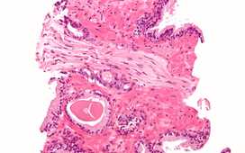 Новый биомаркер рака предстательной железы