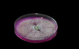 Риск инфекционных осложнений мочекаменной болезни у женщин в два раза выше