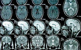 Симптомы ГМП и паркинсонизма связаны между собой