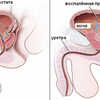 Основные симптомы хронического простатита