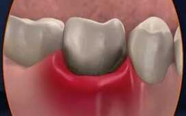 Воспаление десен вредит эрекции