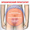 К каким последствиям может привести хроническая форма этого мужского заболевания?