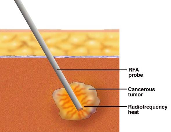 Радиочастотная аблация рака предстательной железы